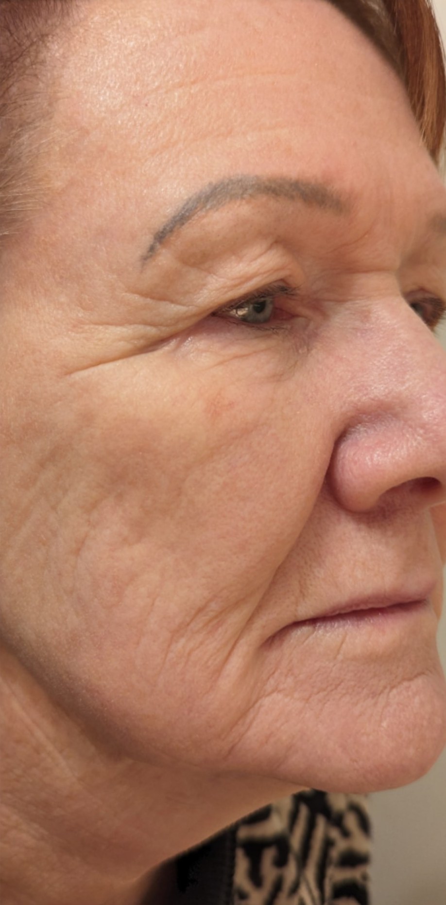 Lumecca IPL · Face, after photo