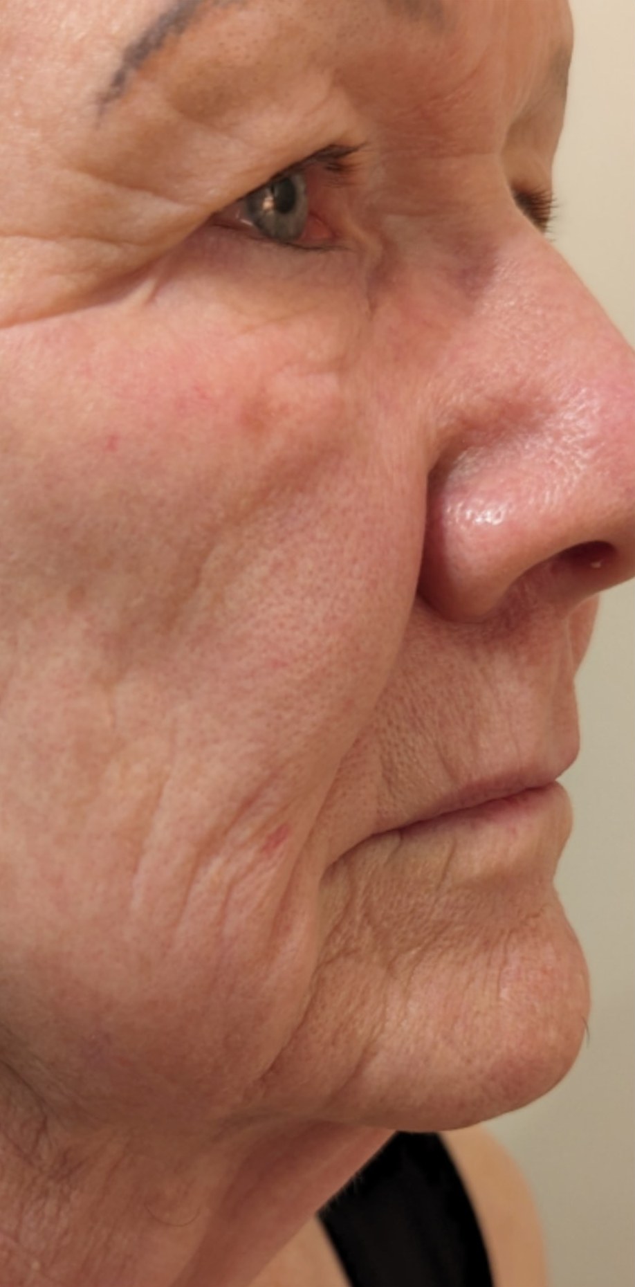 Lumecca IPL · Face, before photo