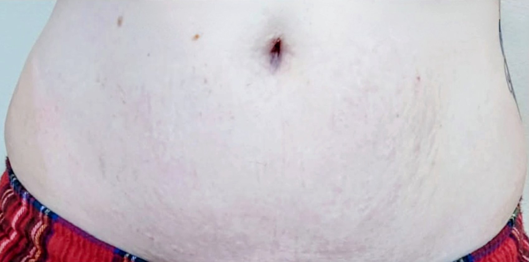 Morpheus8 Body · Abdomen, after photo