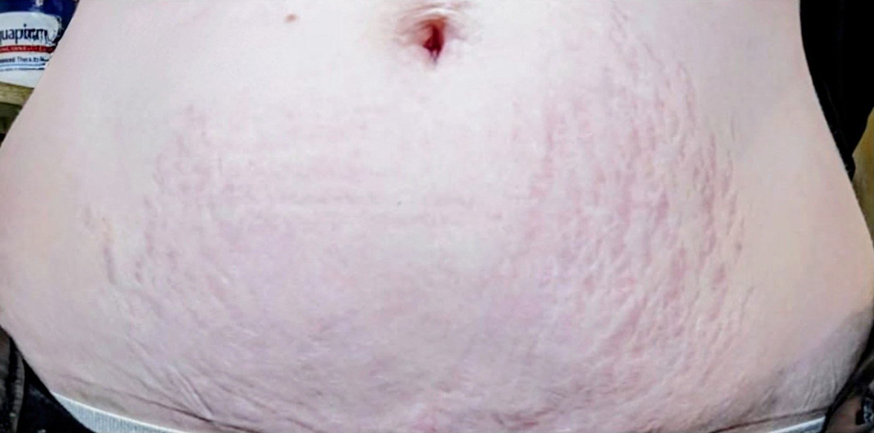 Morpheus8 Body · Abdomen, before photo