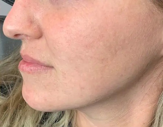 Lumecca IPL · Face, after photo