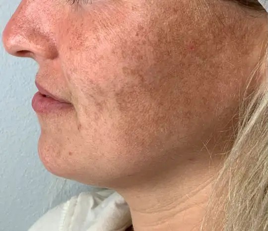 Lumecca IPL · Face, before photo