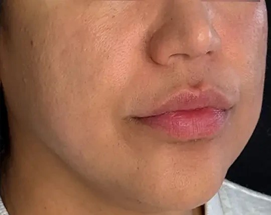 Morpheus8 · Face, after photo