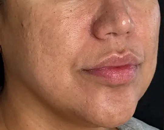 Morpheus8 · Face, before photo