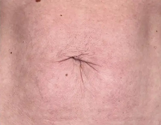 Morpheus8 Body · Abdomen, after photo