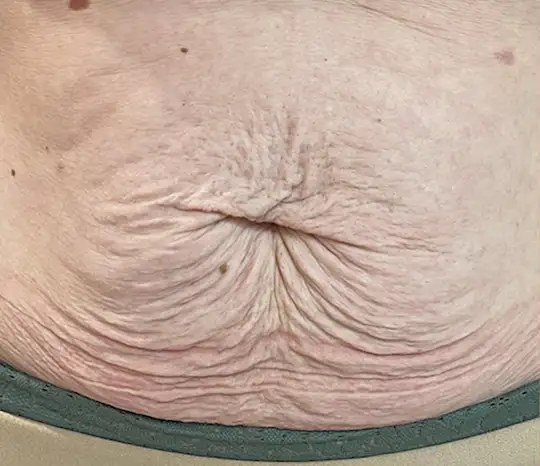 Morpheus8 Body · Abdomen, before photo