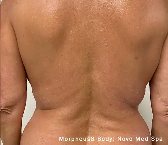 Morpheus8 Body · Abdomen, after photo