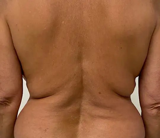 Morpheus8 Body · Abdomen, before photo