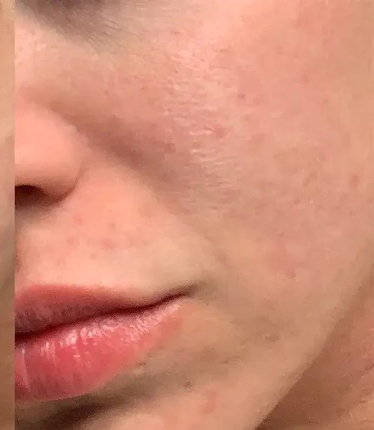 Morpheus8 · Face, after photo
