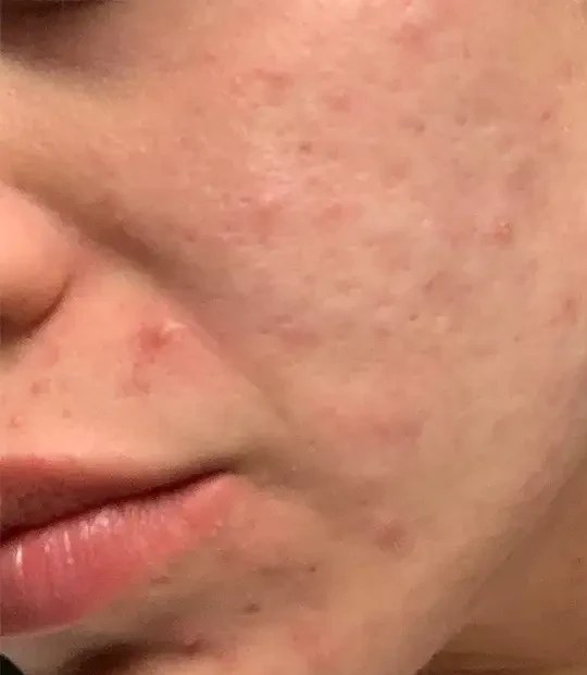 Morpheus8 · Face, before photo