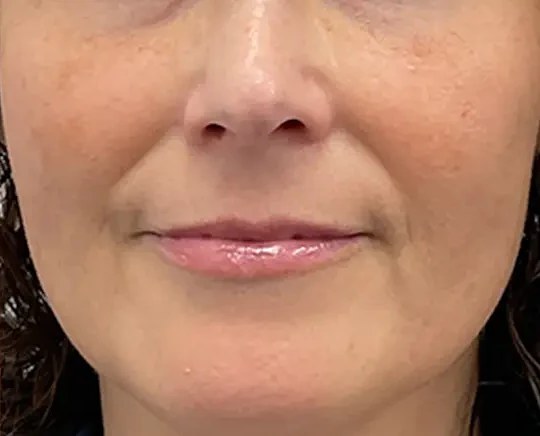 Morpheus8 · Face, after photo