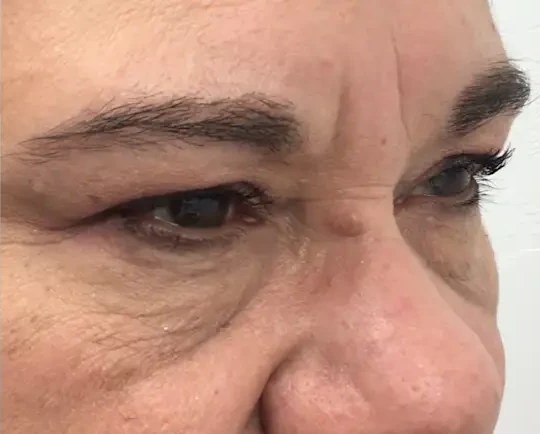 Morpheus8 · Eye Area, after photo