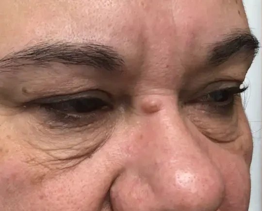 Morpheus8 · Eye Area, before photo