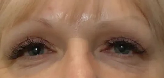 Morpheus8 · Eye Area, after photo