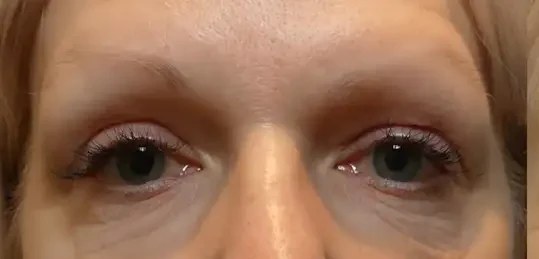 Morpheus8 · Eye Area, before photo