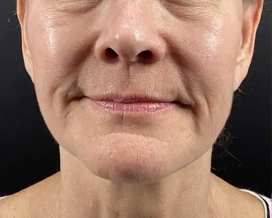 Morpheus8 · Face, before photo