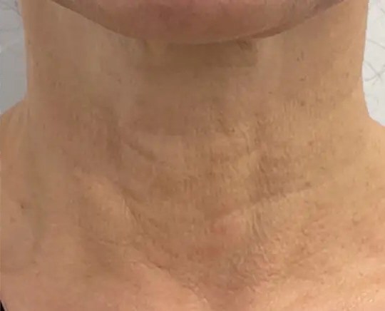 Morpheus8 · Neck, after photo