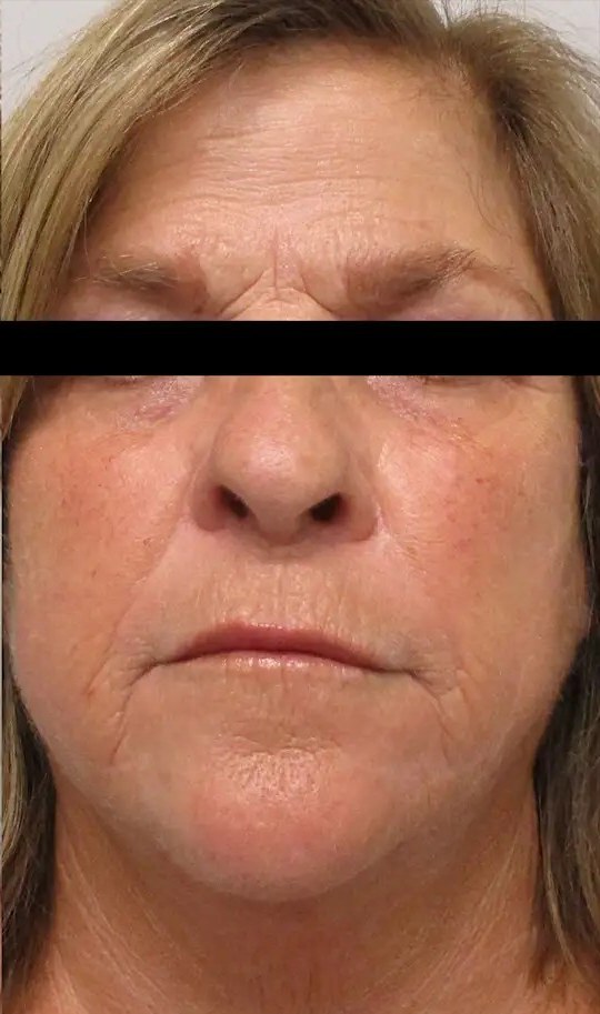 Morpheus8 · Face, after photo