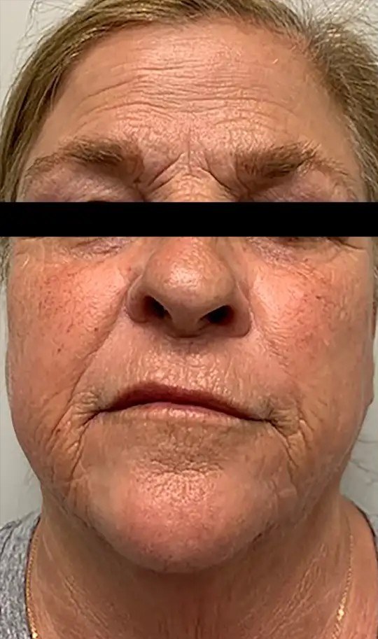 Morpheus8 · Face, before photo