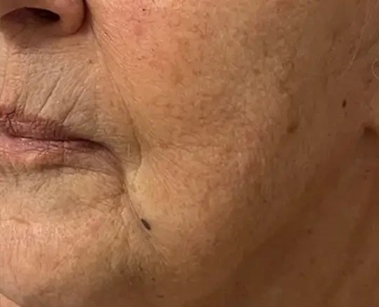 Morpheus8 · Face, after photo