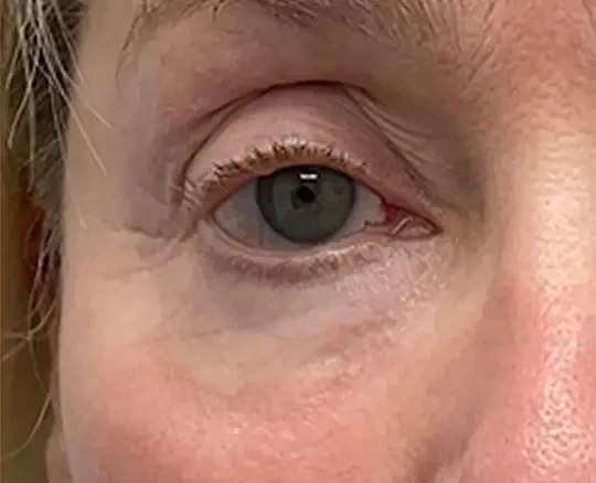 Lumecca + Morpheus8 · Eye Area, after photo