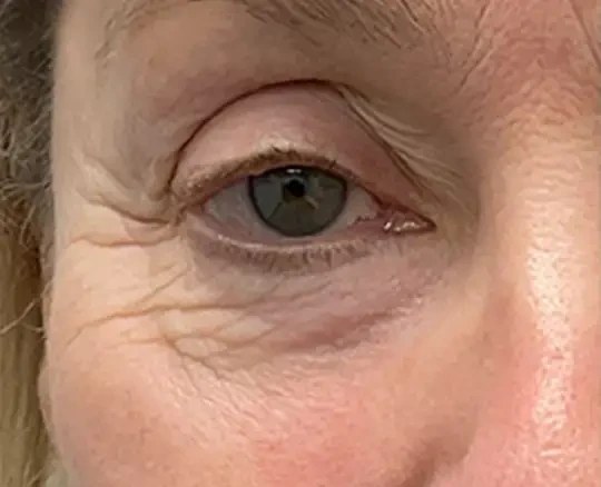 Lumecca + Morpheus8 · Eye Area, before photo