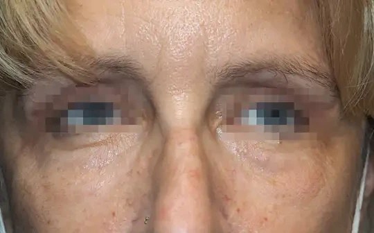 Morpheus8 · Eye Area, after photo