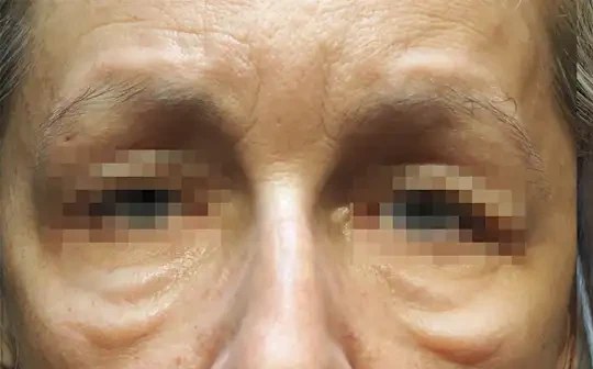 Morpheus8 · Eye Area, before photo