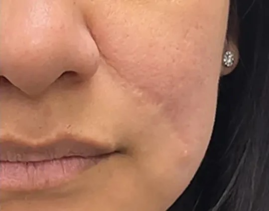 Morpheus8 · Face, after photo