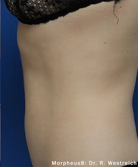 Morpheus8 Body · Abdomen, after photo