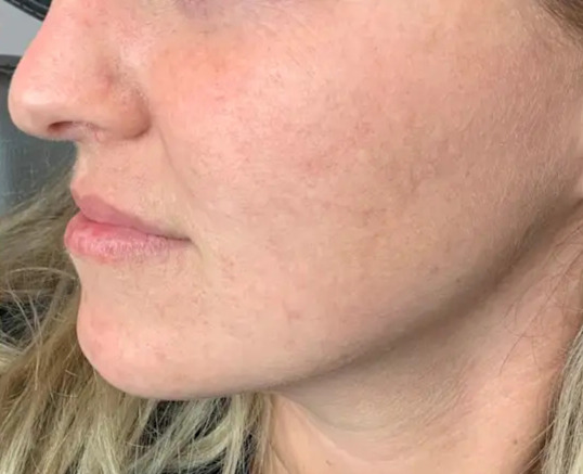 Lumecca IPL · Tone after