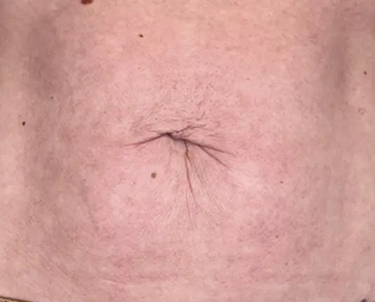 Morpheus Body · Skin Texture after