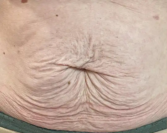 Morpheus Body · Skin Texture before