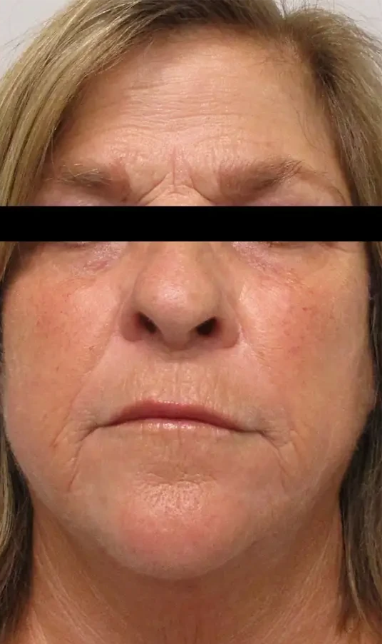 Morpheus8 · Face after