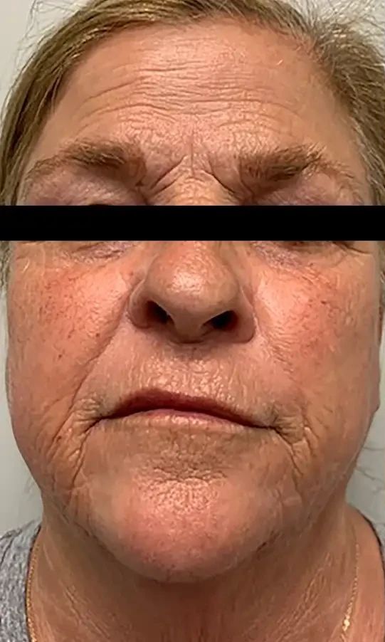 Morpheus8 + CO₂ · Face, before photo