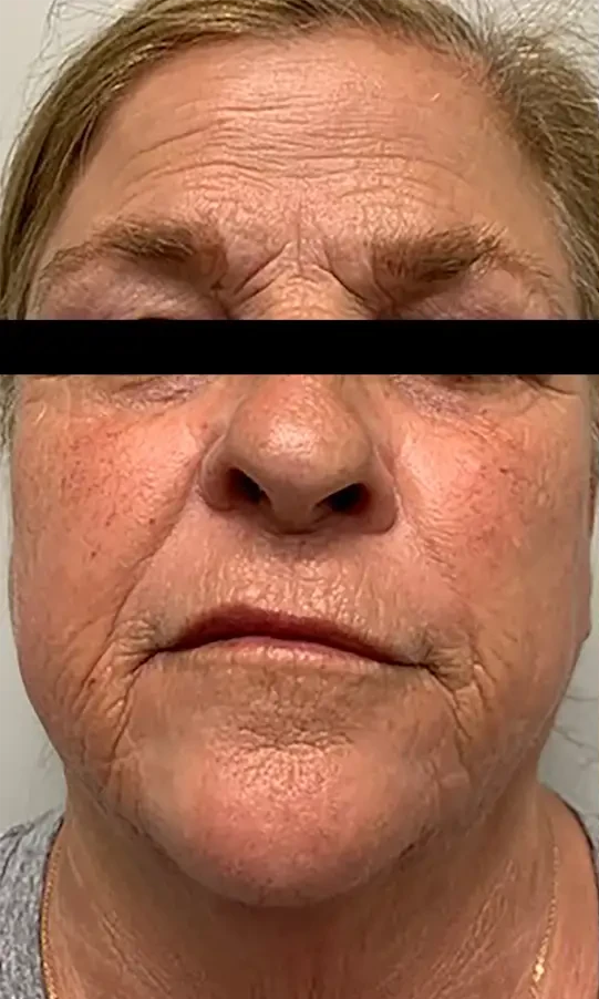 Morpheus8 · Face before